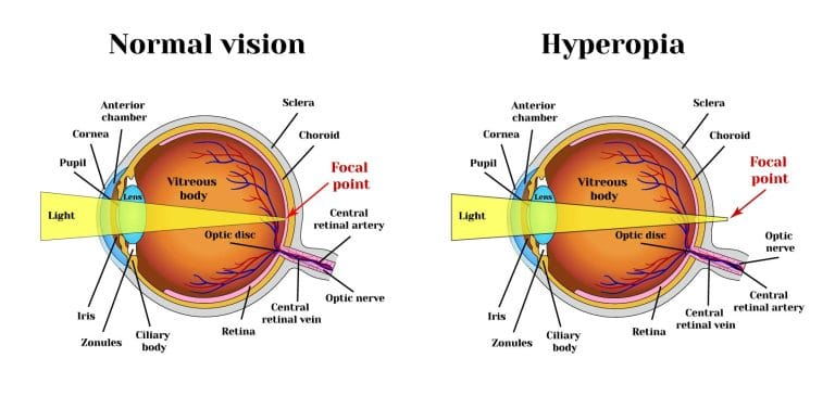 Hyperopia