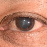 Cataract In Singapore