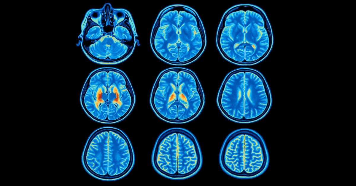 Kenali Seputar Fluorodeoxyglucose PET Scan (FDG PET Scan)