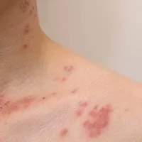 Vaksin Cacar Api atau Shingles