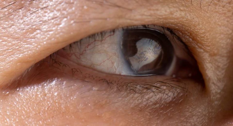 Katarak - The Big Story