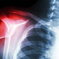 arthritis pada bahu